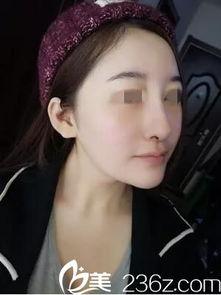 欧美隆鼻案例分享图片,揭秘明星美鼻的秘密